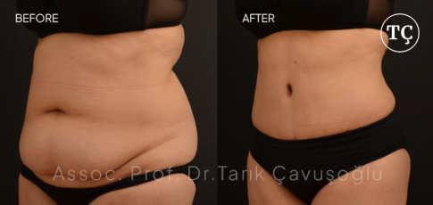 Tummy Tuck Before After