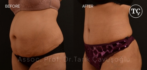Tummy Tuck Before After