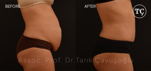 Tummy Tuck Before After