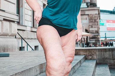 10 Facts About Lipedema