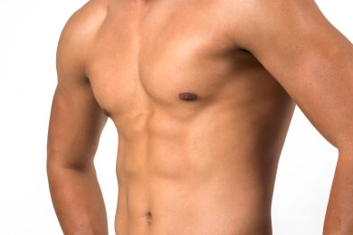 Breast Deformity After Gynecomastia Surgery