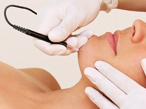 Electrolysis for Hair Removal