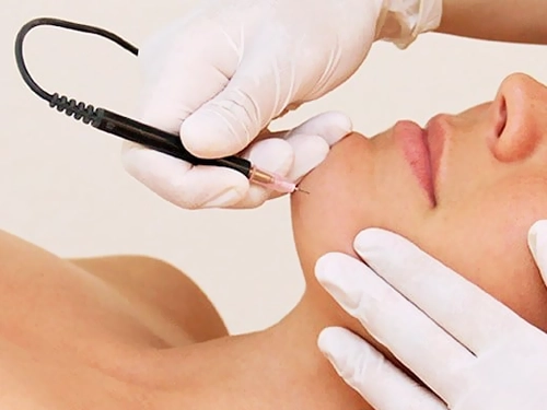 Electrolysis For Hair Removal