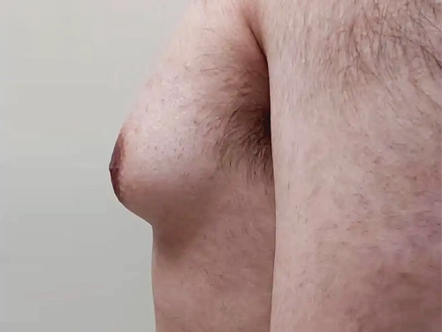 Jinekomasti Nedir? Nedenleri, Tedavisi