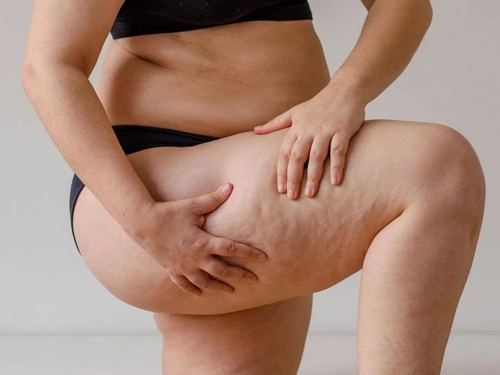 Lipödem Ameliyatı Riskli midir?