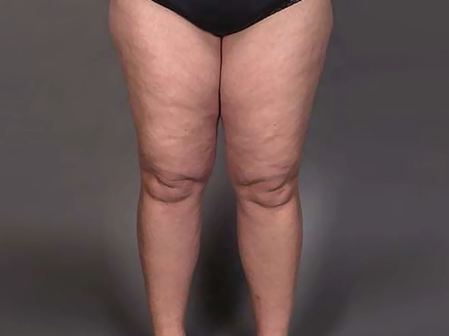 Lipödem Evreleri Nelerdir?