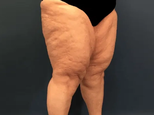 Lipödem Tanısı Neden Geç Konur?