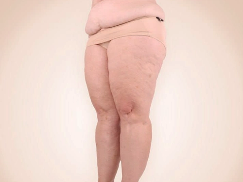 Lipödemli Hastalar Diyet ve Spor ile Kilo Veremiyor mu?