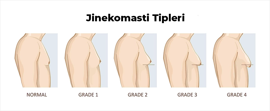 Jinekomasti Tipleri